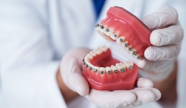 ¿Cuáles son los mejores brackets para ortodoncia?