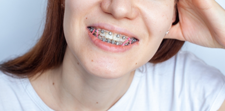 ¿Por qué se usan los elásticos en tratamientos de ortodoncia?