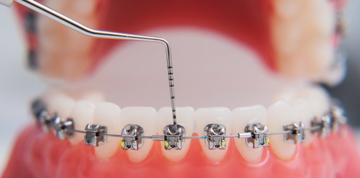 La importancia de usar un buen instrumental de ortodoncia