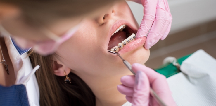 ¿Bandas o tubos de ortodoncia? ¿Qué es mejor?