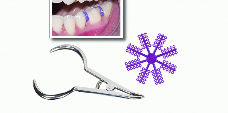 Separadores de ortodoncia: Tipos y usos