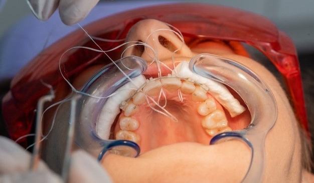 Qué son los retenedores dentales y cual es su función