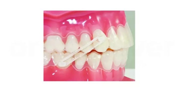 ¿Cómo escoger el atache dental y retención lingual para alineadores?