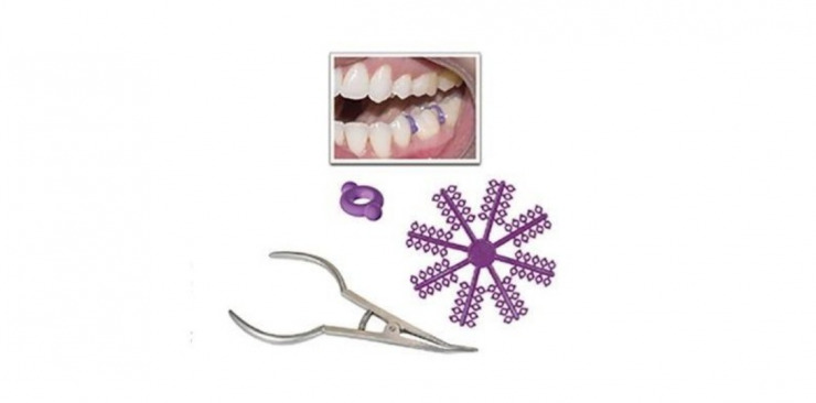 Las 5 preguntas y respuestas para conocer los separadores dentales en ortodoncia